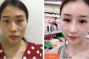 廣西愛思特整形外科醫(yī)院李俊明整形價(jià)格表附鼻部綜合案例展示