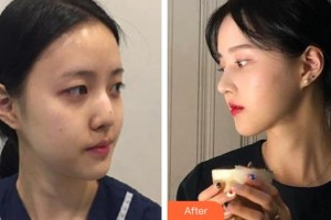 廣西壯族自治區(qū)人民醫(yī)院整形美容中心黃欣整形價(jià)格表附鼻部綜合案例展示