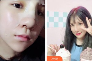 廣西民族醫(yī)院醫(yī)學(xué)美容科楊竟忠整形價(jià)格表附鼻部綜合案例展示