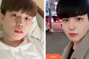 廣西中醫(yī)院第一附屬醫(yī)院美膚激光整形美容科韋文朗整形價(jià)格表附鼻部綜合案例展示