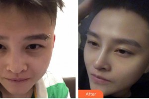 廣西中醫(yī)院第一附屬醫(yī)院美膚激光整形美容科林輝整形價(jià)格表附鼻部綜合案例展示