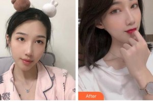 廣西東方整形美容醫(yī)院程健整形價(jià)格表附鼻部綜合案例展示