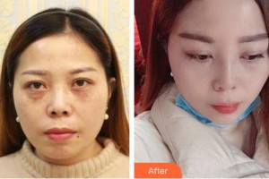 武警廣西總隊(duì)醫(yī)院醫(yī)學(xué)整形美容中心李奎昊整形價(jià)格表附鼻部綜合案例展示