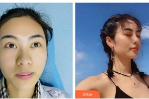 廣西東方整形美容醫(yī)院劉和平整形價(jià)格表附耳軟骨復(fù)合隆鼻案例展示