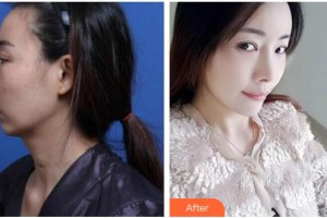 廣西醫(yī)科大學(xué)第一附屬醫(yī)院整形美容科黃安林整形價(jià)格表附鼻修復(fù)案例展示