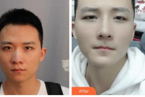 廣西醫(yī)科大學(xué)第一附屬醫(yī)院整形美容科王潤秀整形價(jià)格表附鼻部綜合案例展示