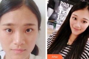 武警廣西總隊(duì)醫(yī)院醫(yī)學(xué)整形美容中心韋炳朝整形價(jià)格表附鼻部綜合案例展示