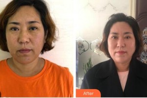 廣西中醫(yī)藥大學(xué)附屬瑞康醫(yī)院整形美容中心李莉整形價(jià)格表附切開雙眼皮案例展示