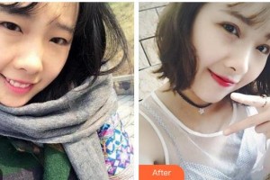 廣西中醫(yī)藥大學(xué)附屬瑞康醫(yī)院整形美容中心林忠整形價(jià)格表附切開雙眼皮案例展示