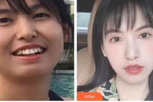 廣西中醫(yī)藥大學(xué)附屬瑞康醫(yī)院整形美容中心吳偉民整形價(jià)格表附金屬托槽矯正案例展示