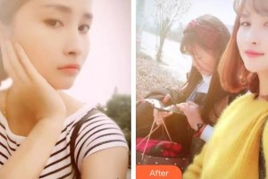 廣西愛思特整形外科醫(yī)院楊其峰整形價(jià)格表附美白貼片案例展示