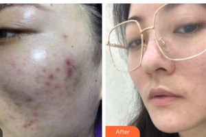 廣西東方整形美容醫(yī)院楊競(jìng)忠整形價(jià)格表附去痘印痘坑案例展示