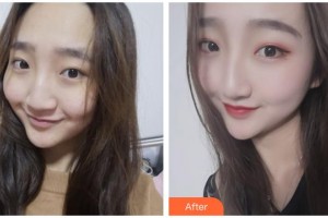 廣西醫(yī)科大學(xué)第一附屬醫(yī)院整形美容科梁自乾整形價(jià)格表附激光祛斑案例展示