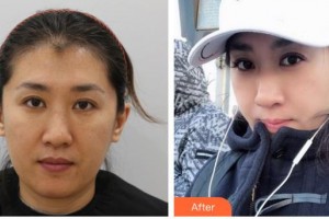 武警廣西總隊(duì)醫(yī)院醫(yī)學(xué)整形美容中心陳嘉莉整形價(jià)格表附清潔祛痘案例展示