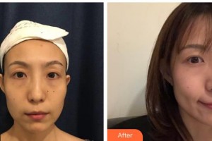 武警廣西總隊(duì)醫(yī)院醫(yī)學(xué)整形美容中心雷素龍整形價(jià)格表附去痘印痘坑案例展示