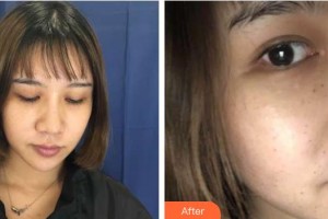 武警廣西總隊(duì)醫(yī)院醫(yī)學(xué)整形美容中心李信峰整形價(jià)格表附去痘印痘坑案例展示