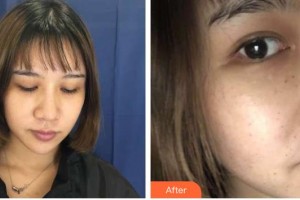 武警廣西總隊(duì)醫(yī)院醫(yī)學(xué)整形美容中心王玉燕整形價(jià)格表附去痘印痘坑案例展示