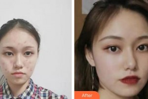 廣西愛思特整形外科醫(yī)院趙彩明整形價(jià)格表附紅藍(lán)光祛痘案例展示