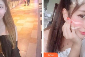 廣西東方整形美容醫(yī)院龍海波整形價(jià)格表附彩光嫩膚案例展示