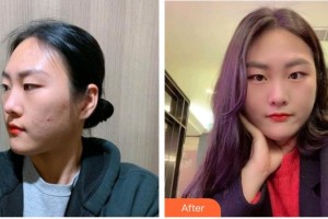 廣西醫(yī)科大學(xué)第一附屬醫(yī)院整形美容科蒙誠躍整形價(jià)格表附清潔祛痘案例展示