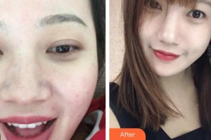 廣西東方整形美容醫(yī)院韋婷整形價(jià)格表附激光祛斑案例展示