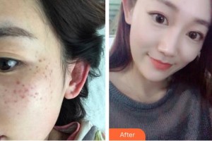 廣西愛思特整形外科醫(yī)院蘇英整形價(jià)格表附激光祛斑案例展示