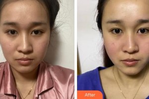 廣西愛思特整形外科醫(yī)院劉慶豐整形價(jià)格表附埋線提升案例展示