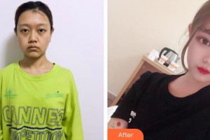 廣西愛思特整形外科醫(yī)院林泉整形價(jià)格表附埋線提升案例展示