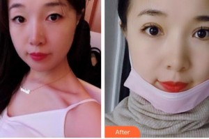 廣西來賓愛爾眼科醫(yī)院肖瀟整形價(jià)格表附眼部綜合案例展示