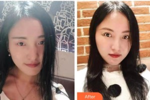 廣西來賓愛爾眼科醫(yī)院梁玉耕整形價(jià)格表附眼部綜合案例展示