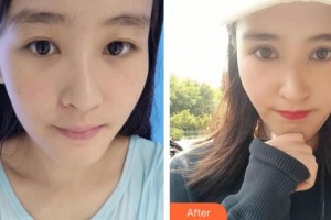 廣西來賓愛爾眼科醫(yī)院謝耀元整形價(jià)格表附切開雙眼皮案例展示