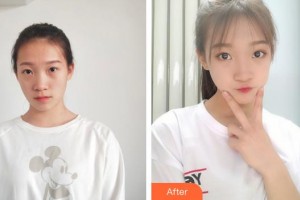 廣西愛思特整形外科醫(yī)院韋強(qiáng)整形價(jià)格表附眼部綜合案例展示