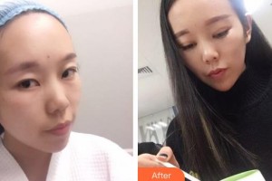 廣西來賓愛爾眼科醫(yī)院伍偉峰整形價(jià)格表附眼部綜合案例展示