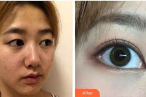 柳州愛爾眼科醫(yī)院黃俊豪整形價(jià)格表附眼部綜合案例展示