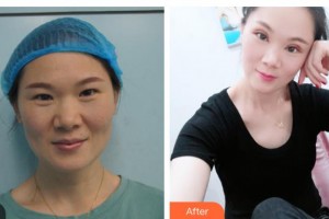 柳州愛爾眼科醫(yī)院黃明海整形價格表附切開雙眼皮案例展示