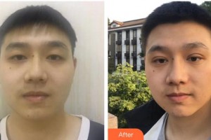 柳州紅十字會眼科醫(yī)院王歡燕整形價(jià)格表附切開雙眼皮案例展示