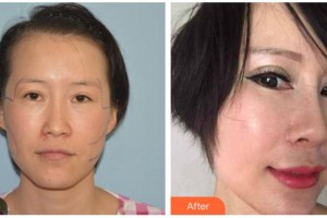 柳州紅十字會眼科醫(yī)院鄧秋瓊整形價(jià)格表附切開雙眼皮案例展示