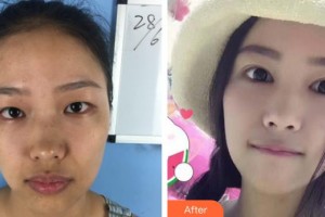 柳州愛爾眼科醫(yī)院黃明漢整形價格表附眼部綜合案例展示