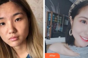 柳州紅十字會眼科醫(yī)院譚顯里整形價格表附眼部綜合案例展示