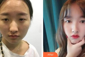 柳州紅十字會眼科醫(yī)院范俊整形價格表附眼部綜合案例展示