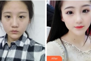 柳州市人民醫(yī)院眼科馬翔整形價格表附眼部綜合案例展示