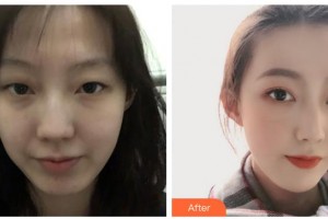 柳州市中醫(yī)醫(yī)院眼科萬小波整形價格表附眼部綜合案例展示