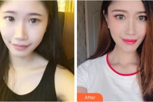 桂林醫(yī)學(xué)院第二附屬醫(yī)院眼科秦程整形價格表附切開雙眼皮案例展示