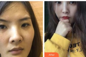 桂林醫(yī)學(xué)院第二附屬醫(yī)院眼科覃蓓整形價格表附眼部綜合案例展示