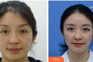 桂林醫(yī)學(xué)院第二附屬醫(yī)院眼科周友弟整形價格表附切開雙眼皮案例展示