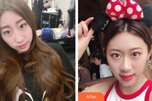 桂林市人民醫(yī)院眼科岳靜整形價(jià)格表附外切祛眼袋案例展示