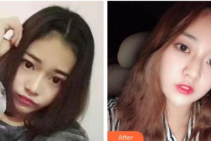 桂林市人民醫(yī)院眼科徐鶯歌整形價(jià)格表附埋線雙眼皮案例展示