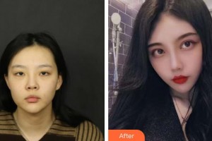 桂林市人民醫(yī)院眼科張玉明整形價(jià)格表附眼部綜合案例展示