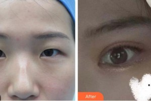 桂林市人民醫(yī)院眼科李柏堅(jiān)整形價(jià)格表附眼部綜合案例展示