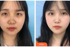 桂林市人民醫(yī)院眼科整形價(jià)格表附眼部綜合案例展示